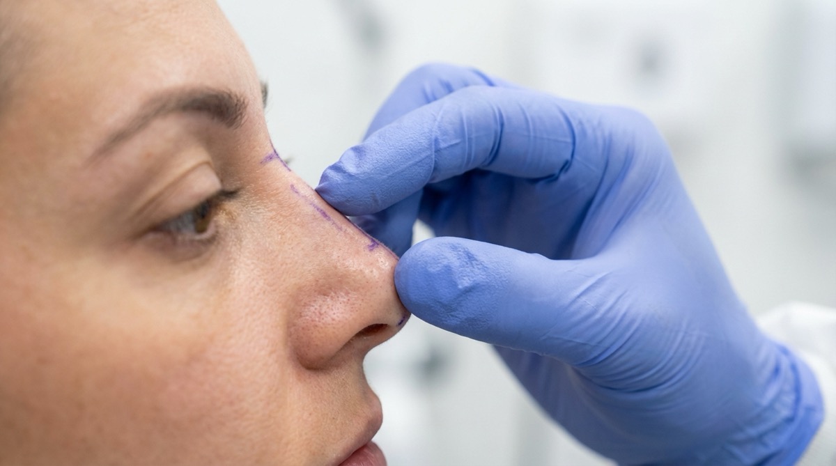 Revision Rhinoplasty: When and Why You May Need a Second Nose Surgery